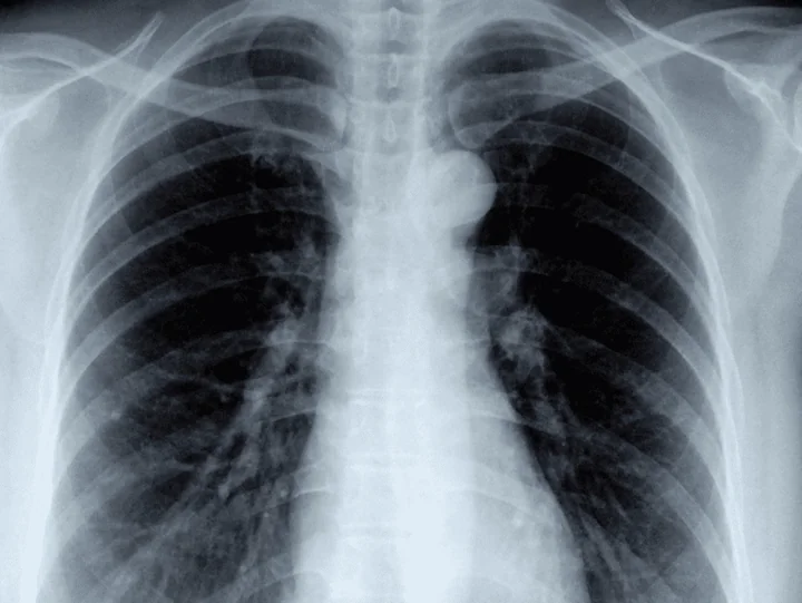 Kiedy należy wykonać RTG klatki piersiowej? Wskazania, przebieg i rola badania w diagnostyce