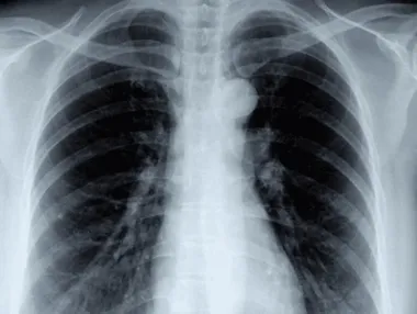 Kiedy należy wykonać RTG klatki piersiowej? Wskazania, przebieg i rola badania w diagnostyce